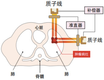 質(zhì)子治療技術(shù)