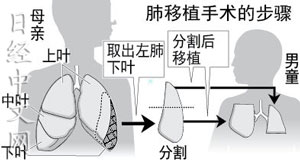 日本成功實施全球較精細活體肺移植手術(shù)（圖）