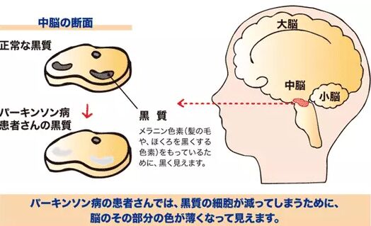 阿爾茨海默病