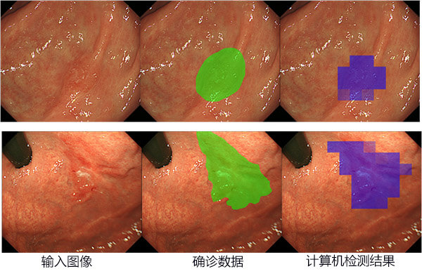 日本研究出早期胃癌檢測(cè)方法