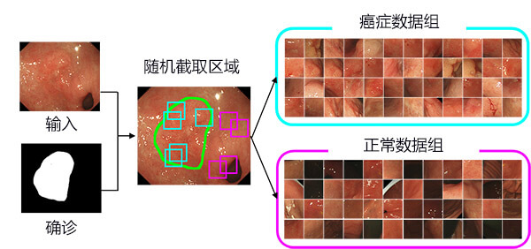 日本研究出早期胃癌檢測(cè)方法