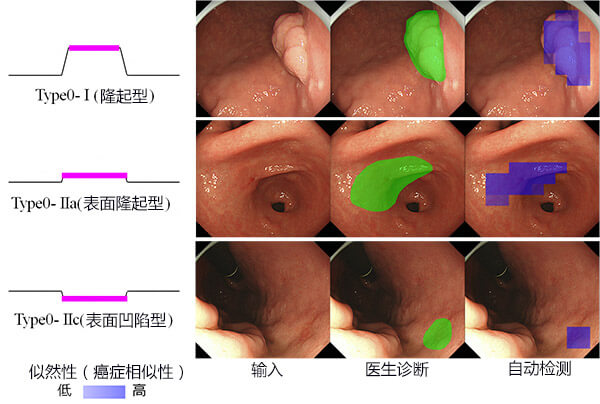 日本研究出早期胃癌檢測(cè)方法