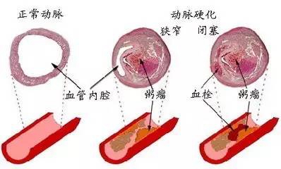 日本治療冠狀動(dòng)脈粥樣硬化