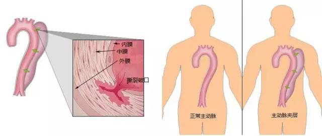 日本治療冠狀動(dòng)脈粥樣硬化