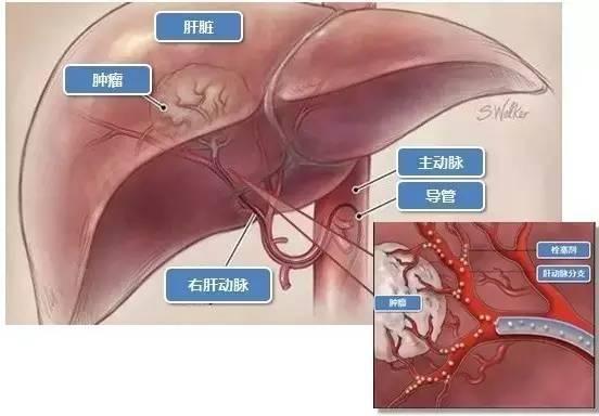 日本治療肝癌