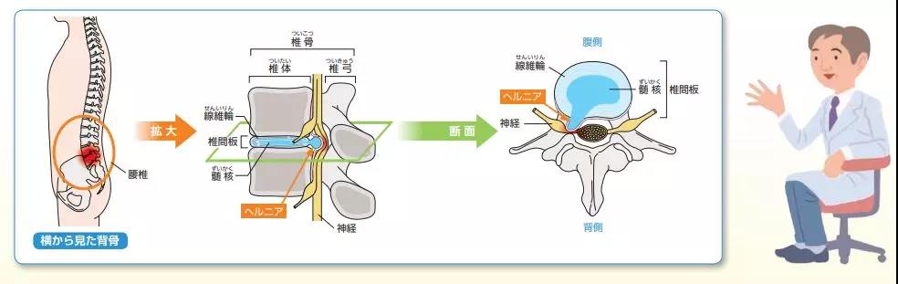 腰間盤突出治療技能