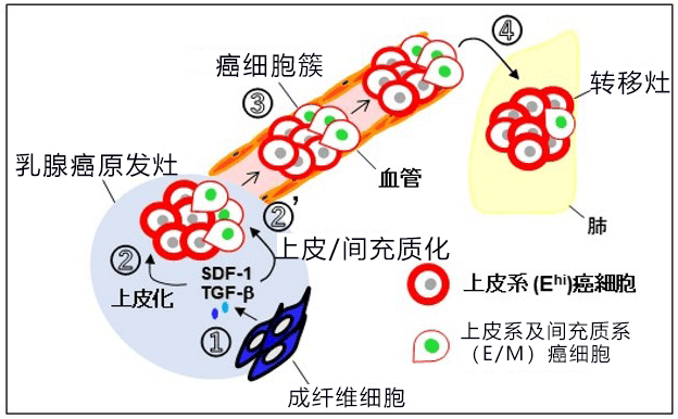 乳腺癌出國治療：日本研究人員發(fā)現(xiàn)乳腺癌浸潤轉(zhuǎn)移新機制！