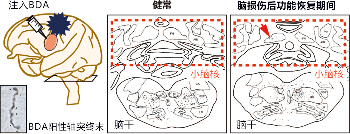 出國看?。貉芯堪l(fā)現(xiàn)大腦損傷后會形成新的神經(jīng)束，或可治療腦部疾病