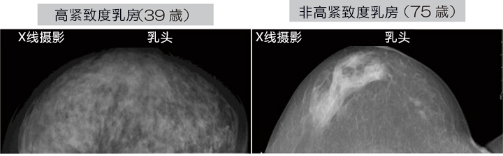 乳腺癌如何檢查？日本開發(fā)出一種新技能可用于早期檢測乳腺癌