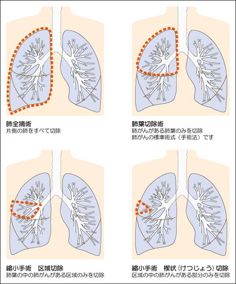 日本肺癌手術(shù)治療方法