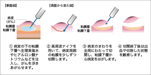 日本早期結(jié)直腸癌治療