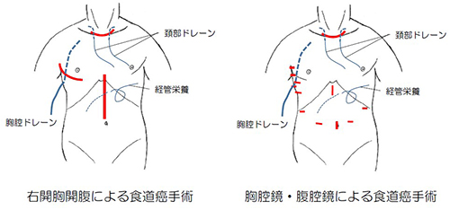 食道癌手術(shù)治療