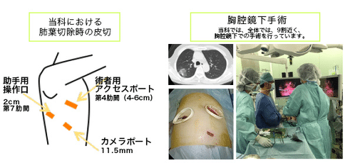 腹腔鏡手術(shù)治療轉(zhuǎn)移性肺癌