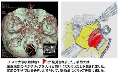 腦血管瘤治療方法