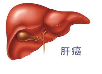 肝癌靶向治療