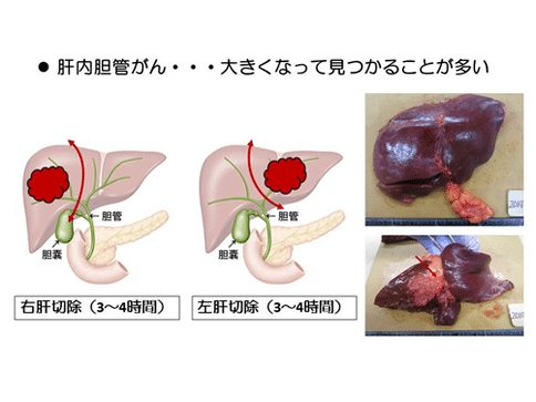 膽管癌手術(shù)治療方案-日本膽管癌權(quán)威醫(yī)院深度分析手術(shù)治療方法