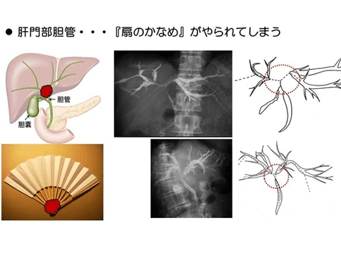 膽管癌手術(shù)治療方案-日本膽管癌權(quán)威醫(yī)院深度分析手術(shù)治療方法