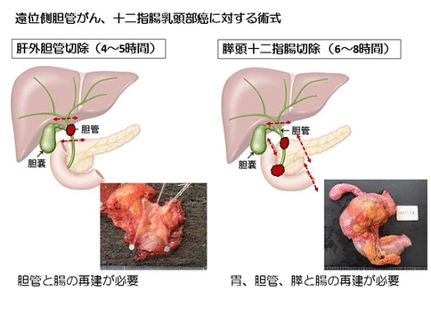 膽管癌手術(shù)治療方案-日本膽管癌權(quán)威醫(yī)院深度分析手術(shù)治療方法