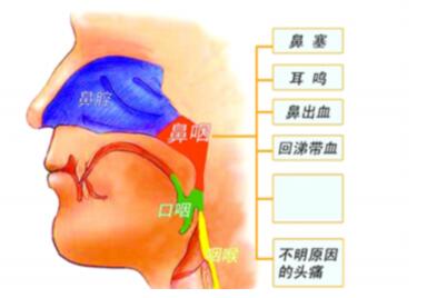 鼻咽癌