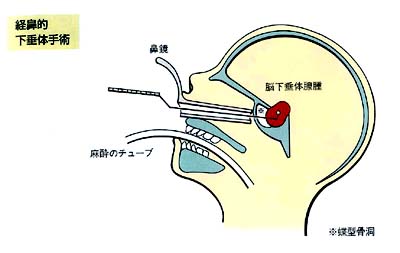 腦垂體瘤手術(shù)