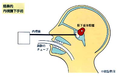 晚期垂體瘤手術(shù)治療