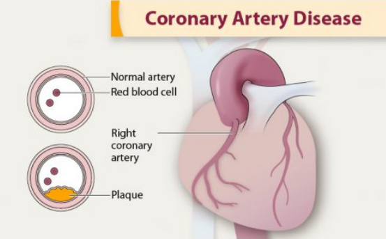 冠心病手術(shù)治療方法