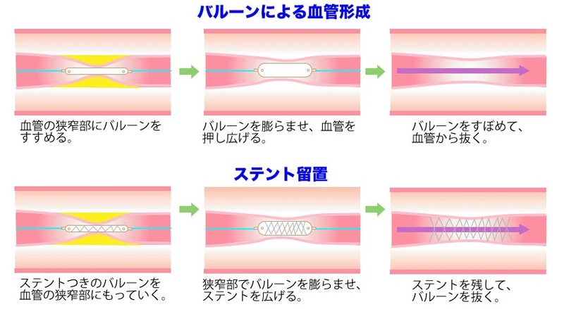 冠心病介入治療