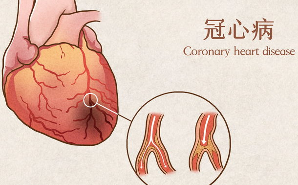 冠心病治療