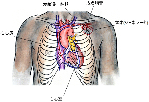 心律不齊治療