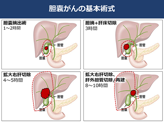 膽囊癌日本治療方法