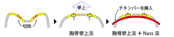 漏斗胸手術(shù)治療