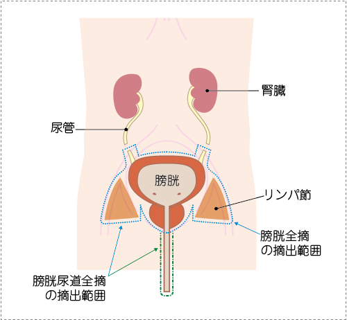 日本治療膀胱癌