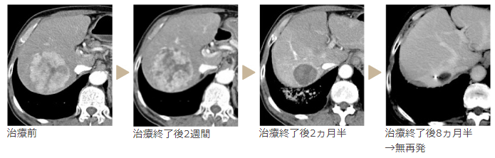 質(zhì)子治療肝癌