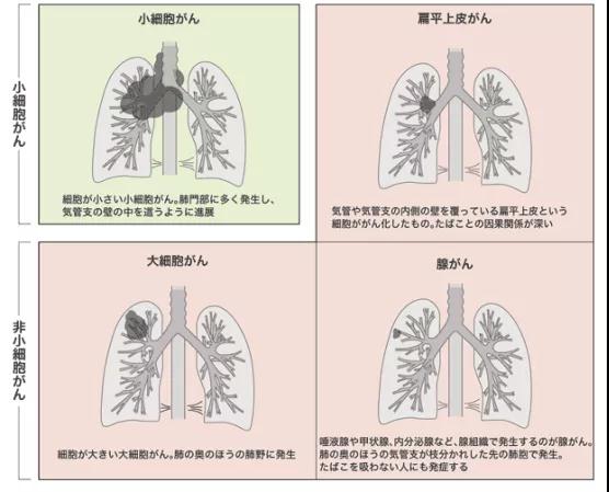 肺癌四種類型