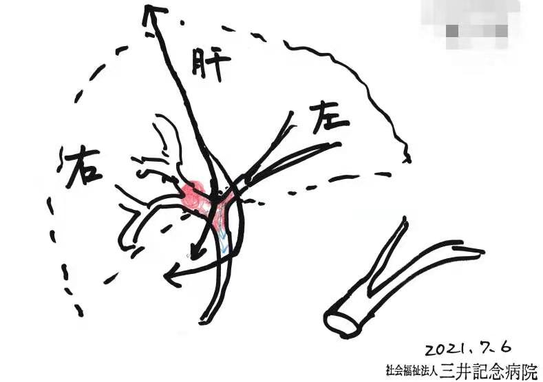 膽管癌手術(shù)治療