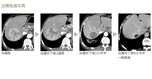 肝癌質(zhì)子治療