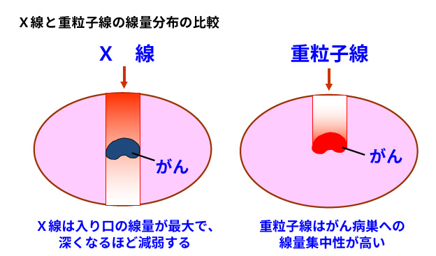 重離子治療骨肉瘤特點