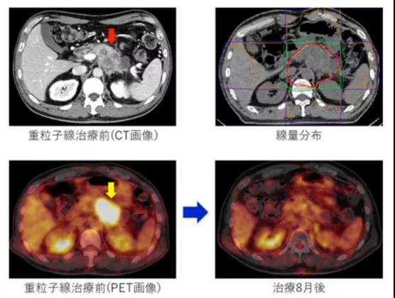 質子重離子治療胰腺癌