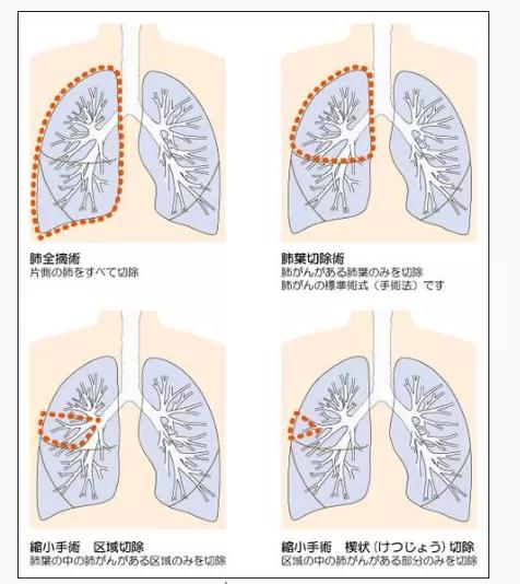 肺癌手術(shù)治療