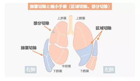 肺癌手術(shù)治療