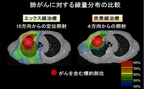 日本重離子治療肺癌