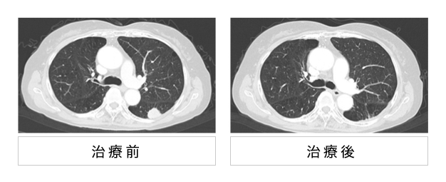 日本重離子治療肺癌媲美手術(shù)