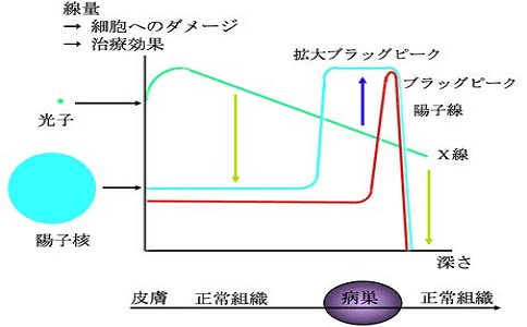 質(zhì)子重離子治療早期肺癌