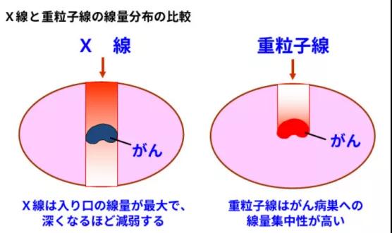 日本重離子治療醫(yī)院