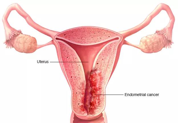 子宮內(nèi)膜癌癥狀