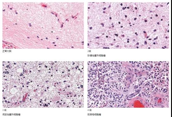 星形細(xì)胞瘤分級
