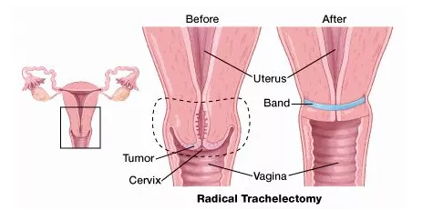 宮頸癌手術(shù)治療