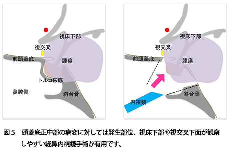 內(nèi)窺鏡顱底手術