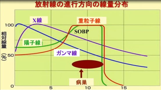 腺樣囊性癌重離子治療