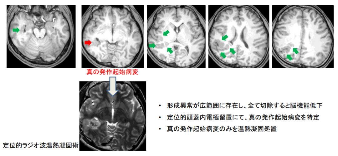 癲癇日本手術(shù)治療